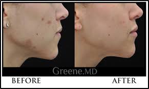 1540 fractional laser before and after. Palomar Laser Skin Rejuvenation Weston Treats Skin Texture Scars And Stretch Marks Fort Lauderdale Miami Laser Center