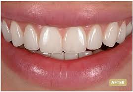 Composite Veneers Make Your Smile Truly Unforgettable