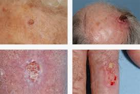 16.04.2021 · other skin cancers generally do not hurt to touch until they have advanced to become large. Symptoms Diagnosis Creating Beauty