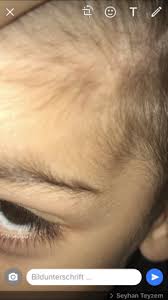 Es passiert immer wieder, dass leute auf die zinken treten. Beule An Stirn Seit 10 Tagen Kinder Kleinkind Kinderarzt