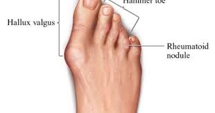 Causes Of Arthritis In The Feet Rheumatoid Arthritis Arthritis Causes Arthritis