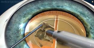 Image result for Cataract Extraction