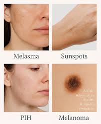 Image result for Melasma