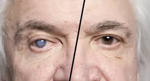 Image result for Cataract Extraction