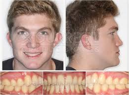 Surgical Orthodontics