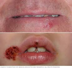 You might also notice some small discolored or white bumps starting to form. Cold Sore Symptoms And Causes Mayo Clinic