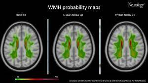 Video 1 Nonlinear Temporal Dynamics Of Cerebral Small Vessel Disease Youtube