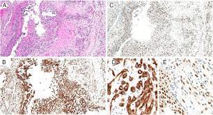 However, literature reported that patients diagnosed with this subtype showed a similar prognosis . Bap1 Facilitates Diagnostic Objectivity Classification And Prognostication In Malignant Pleural Mesothelioma Sciencedirect
