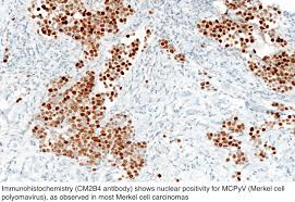 Therefore, the immunohistochemical profile plays a relevant role in confirming the microscopic diagnosis. Pathology Outlines Merkel Cell Carcinoma