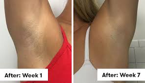 It is because it targets only the hair in the growth phase. I Tried Laser Hair Removal Under My Arms And I Ll Never Shave Again Self
