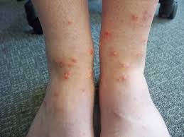 Unlike ticks, chiggers in the united states don't transmit any known diseases. Chiggers Wtf Are They And What Do You Do About Them