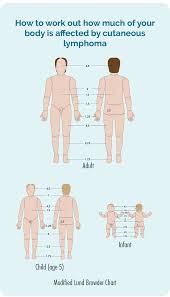 Image result for Lymphoma