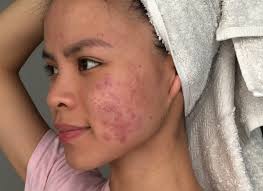 Image result for acne face