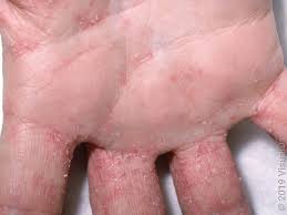 Image result for scabies symptoms