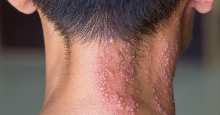 Herpes zoster: o que é, sintomas, tratamento e prevenção