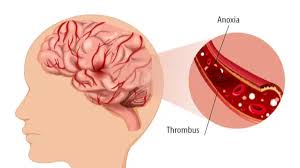 Bildergebnis für CVA
