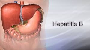 Genotype/ subgenotype distribution of hepatitis b virus among hemodialysis patients with chronical hepatitis b article (pdf available). Hepatitis B Information Mount Sinai New York