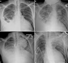 Bilateral pleural effusion toms franquet, md, phd differential diagnosis common congestive heart failure postcardiac injury syndrome infection renal disease metastatic malignant. Authors Instructions For Authors Instructions For Authors Editorial Policies Privacy Policy Copyright Agreement Articles Ms Words Templates Article Processing Charges About Us Editorial Board Faqs About The Pamj Contact The Pamj Supplements Reviewers