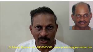 Pin On Hair Transplant In Kolkata