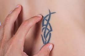The fastest, safest, and most effective way to remove an i went to a laser tattoo removal consultant three weeks after getting the tree tattoo. Common Reasons People Want Tattoo Removal Jeffrey S Gosin Md Facs Board Certified Vascular Surgeon