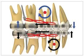 SciELO - Brasil - Biomechanics of extra-alveolar mini-implants Biomechanics  of extra-alveolar mini-implants