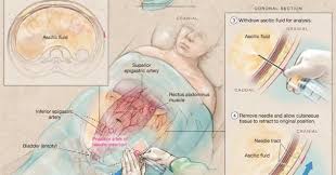 Fluid management is one of the workhorses of junior doctor prescribing; Paracentesis Procedure Mesothelioma Used To Remove Excess Fluid From The Abdominal Cavity Mesothelioma Asbestos Cancer Diagnosis Treatment And Information