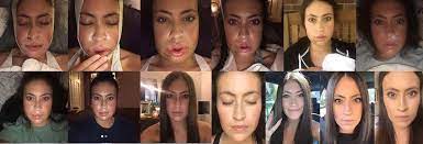 13 Things I Wish I Knew Before Having Double Jaw Surgery