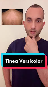 Things you should know about #tineaversicolor or #pityriasisversicolor .  For more 👉🏻 @Dr Ibrahim Salman @Dr Ibrahim Salman #tiktoklongs