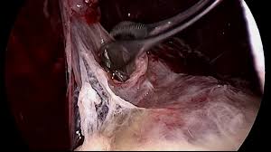 Other causes are complicated parapneumonic effusion , empyema, and tuberculosis. Vats For Loculated Pleural Effusion Dr Amol Bhanushali Youtube