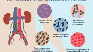 Overview Of Enlarged Retroperitoneal Lymph Nodes