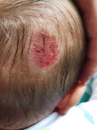 Image result for sores on the head in children
