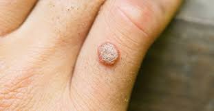 Locurile cele mai afectate de negi sunt mainile, degetele in special. De Ce Apar Veruci Èi De Cate Tipuri Sunt Afla Aici Mai Multe