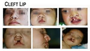 Image result for Lip Exam