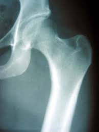 Osteoarthritis Of The Hip Hip Arthritis Uw Orthopaedics And Sports Medicine Seattle
