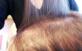 If you ingest a large amount of warfarin, which is found in rat poisons, it can also cause hair loss. Common Causes Of Hair Loss In Your 20 S And 30 S Hairatin
