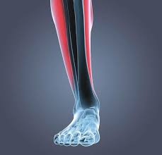 Pain along the inner part of the lower leg. What Are Shin Splints Dr Scholl S