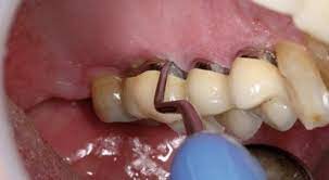 Behandlungsstrategien In Der Parodontologie Zwp Online Das Nachrichtenportal Fur Die Dentalbranche