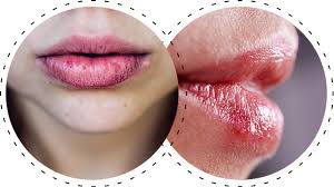 Image result for Lip Cancer