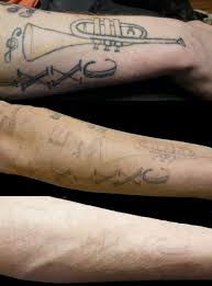 Pulsed laser treatment of tattoos. Laser Tattoo Removal 7 Sessions Beauline Aesthetics