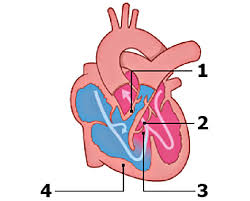 Natural history, complications and prognosis. Schematic Overview Of The Defects Seen In Tetralogy Of Fallot 1 Download Scientific Diagram