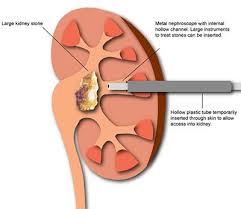 Urology Care Foundation How Are Kidney Stones Treated Kidney Stones Kidney Preventing Kidney Stones