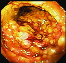 Clostridium difficile es una bacteria que puede causar diarrea y afecciones intestinales más serias, como la colitis. Endoscopic View Of Clostridium Difficile Induced Pseudomembranous Download Scientific Diagram