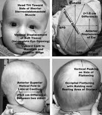 Image result for Positional Head Deformity