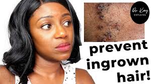 This can range from a small, painless lump to a. How To Get Rid Of Ingrown Hairs Expert Tips That Will Get Rid Of Them For Good Youtube
