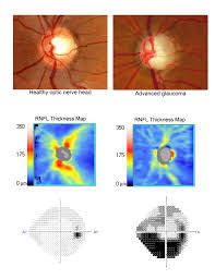 Image result for Glaucoma