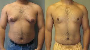 Доброкачественные, предраковые по основной классификации новообразования кожи делятся на доброкачественные и еще такие клетки медленно растут, могут давить на соседние ткани, но никогда в них не проникают. Ginekomastiya U Muzhchin Prichiny Lechenie Mammologicheskij Centr