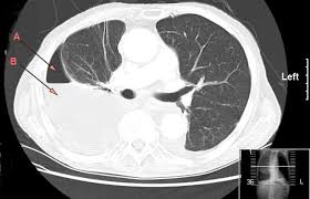 Obliteration of left costophrenic angle with a wide pleural based dome shaped opacity projecting into the lung noted tracking along the cp angle and lateral chest wall suggestive of loculated pleural effusion, however the possibility of empyema can not be ruled out completely. Pleural Empyema Wikipedia