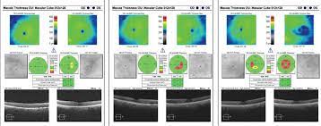 How To Succeed In Plaquenil Screenings