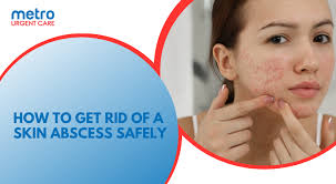 Image result for Skin Abscess
