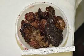 Image result for Bezoar